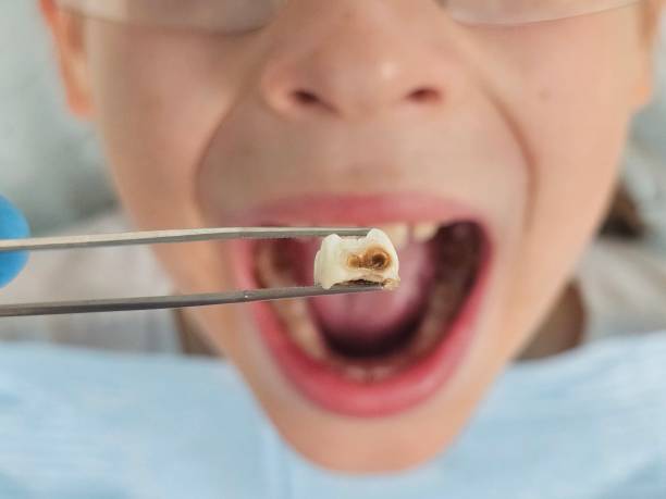 Best Emergency Root Canal Treatment in New Rockford, ND
