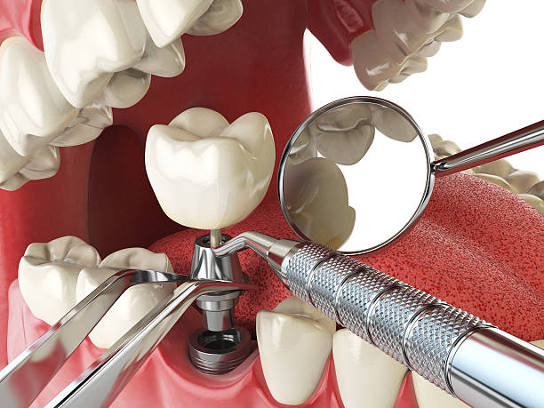Best Emergency Wisdom Teeth Removal in New Rockford, ND